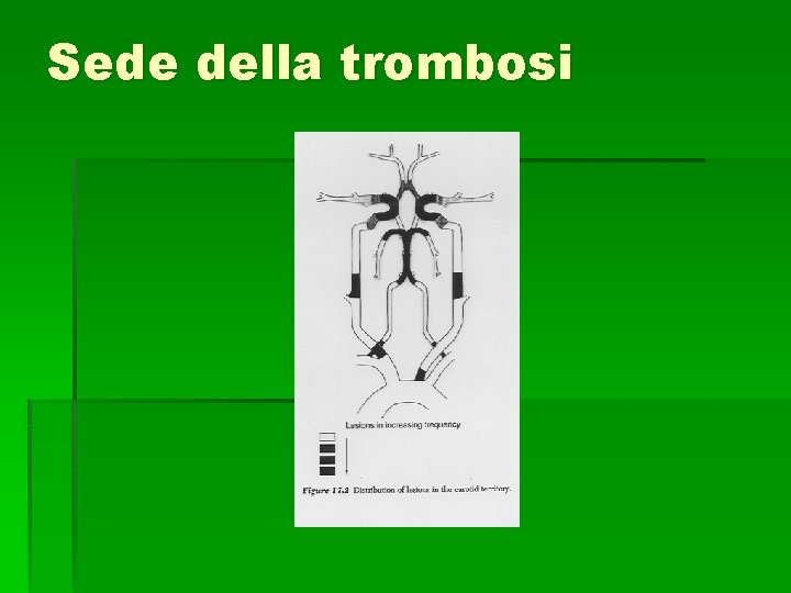 Sede della trombosi Sede della trombosi