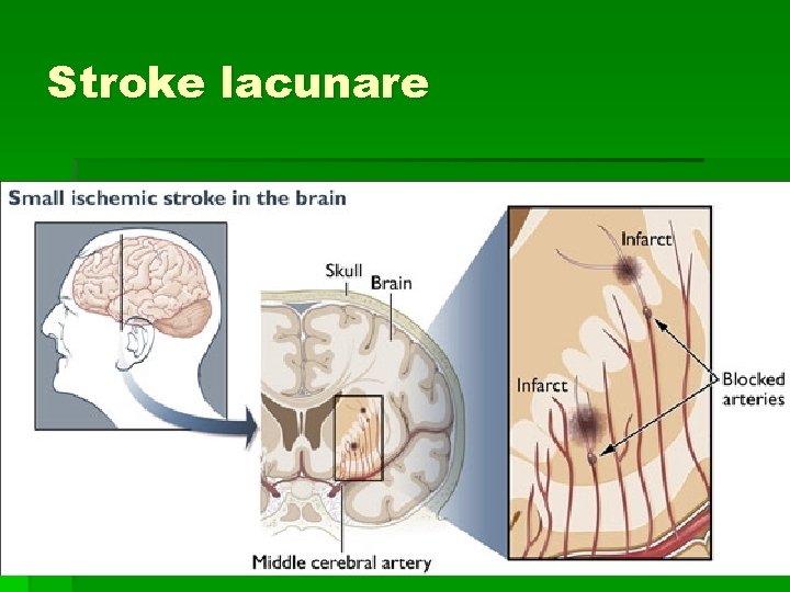 Stroke lacunare Stroke lacunare