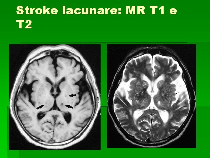 Stroke lacunare: MR T 1 e T 2 Stroke lacunare: MR T 1 e T 2