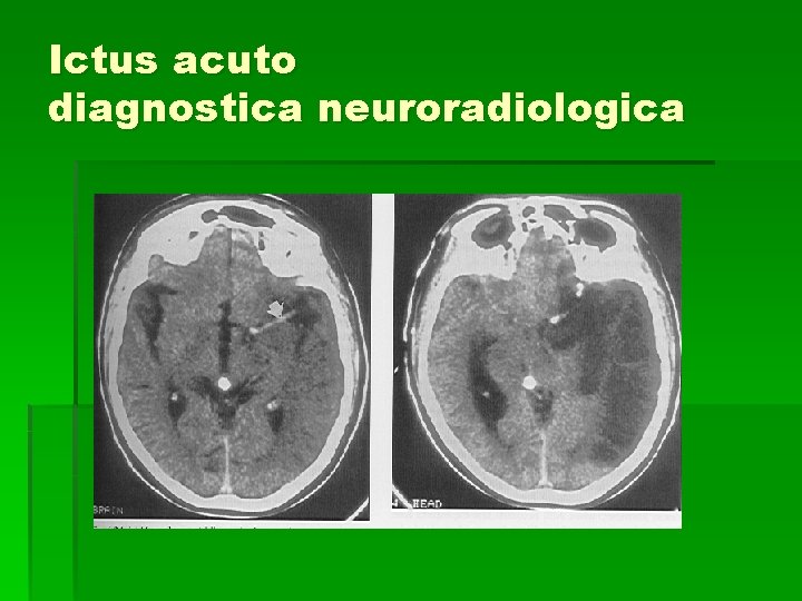 Ictus acuto diagnostica neuroradiologica Ictus acuto diagnostica neuroradiologica