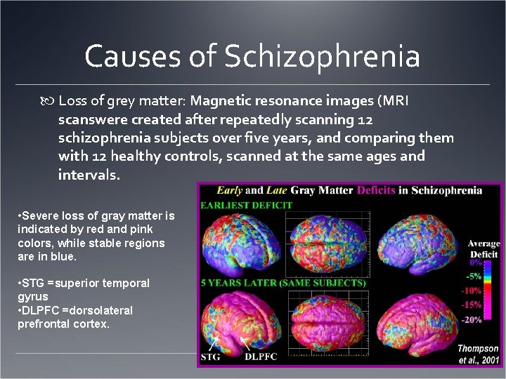 Causes of Schizophrenia Loss of grey matter: Magnetic resonance images (MRI scanswere created after