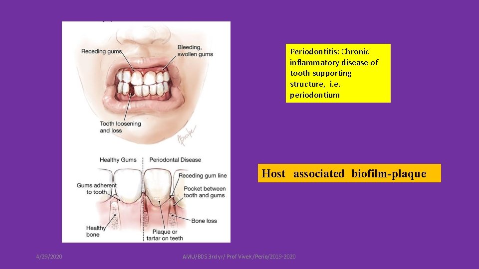 Periodontitis: Chronic inflammatory disease of tooth supporting structure, i. e. periodontium Host associated biofilm-plaque