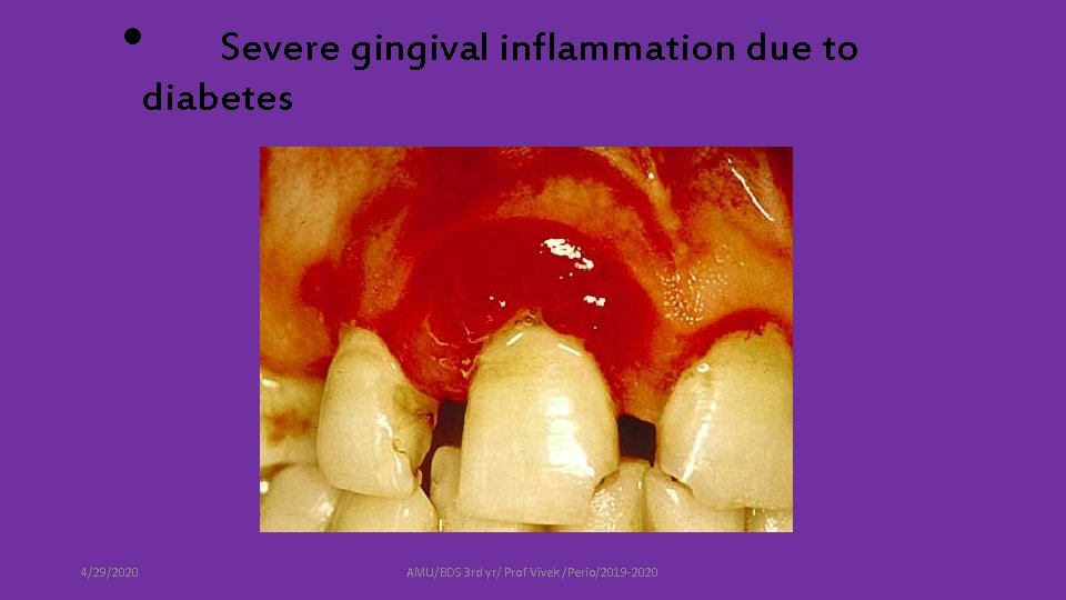  • Severe gingival inflammation due to diabetes 4/29/2020 AMU/BDS 3 rd yr/ Prof