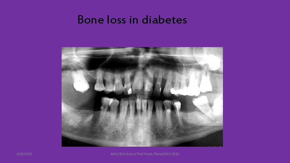  Bone loss in diabetes 4/29/2020 AMU/BDS 3 rd yr/ Prof Vivek /Perio/2019 -2020