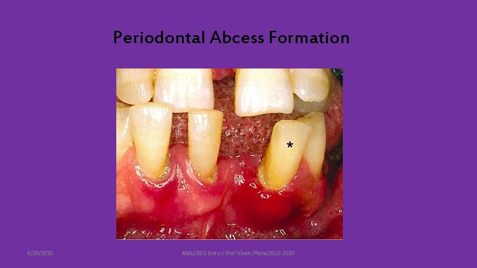 Periodontal Abcess Formation 4/29/2020 AMU/BDS 3 rd yr/ Prof Vivek /Perio/2019 -2020 