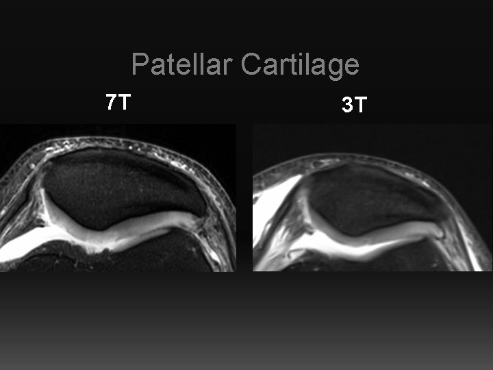 Patellar Cartilage 7 T 3 T 