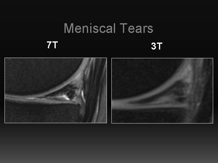 Meniscal Tears 7 T 3 T 