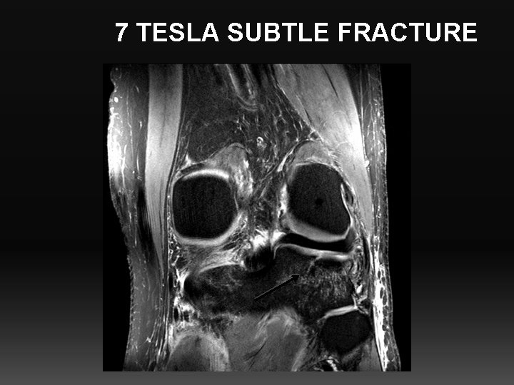 7 TESLA SUBTLE FRACTURE 