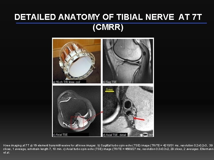 DETAILED ANATOMY OF TIBIAL NERVE AT 7 T (CMRR) Knee imaging at 7 T