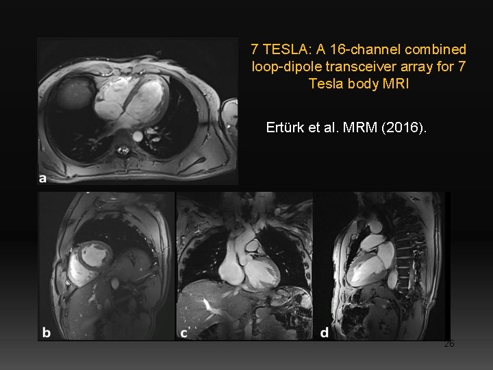 7 TESLA: A 16 -channel combined loop-dipole transceiver array for 7 Tesla body MRI