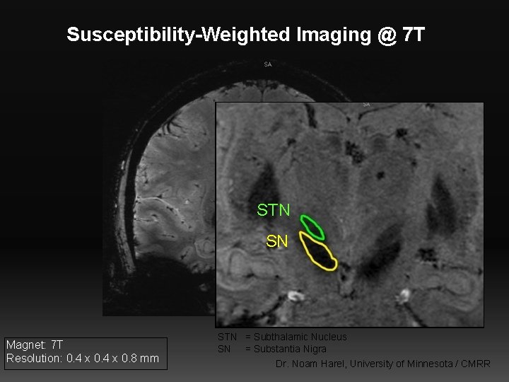 Susceptibility-Weighted Imaging @ 7 T STN SN Magnet: 7 T Resolution: 0. 4 x