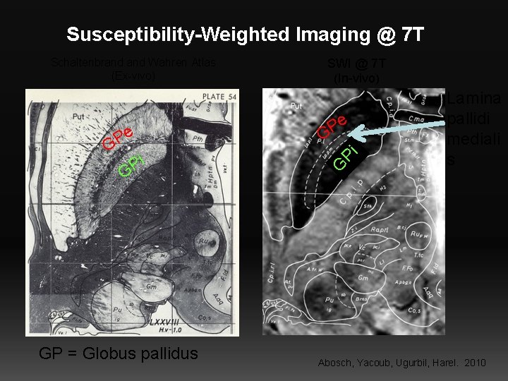 Susceptibility-Weighted Imaging @ 7 T i P G GP = Globus pallidus e P