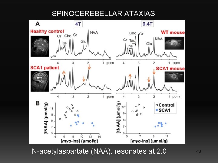 SPINOCEREBELLAR ATAXIAS N-acetylaspartate (NAA): resonates at 2. 0 40 