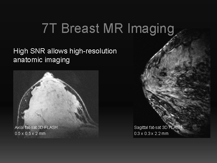 7 T Breast MR Imaging High SNR allows high-resolution anatomic imaging Axial fat-sat 3