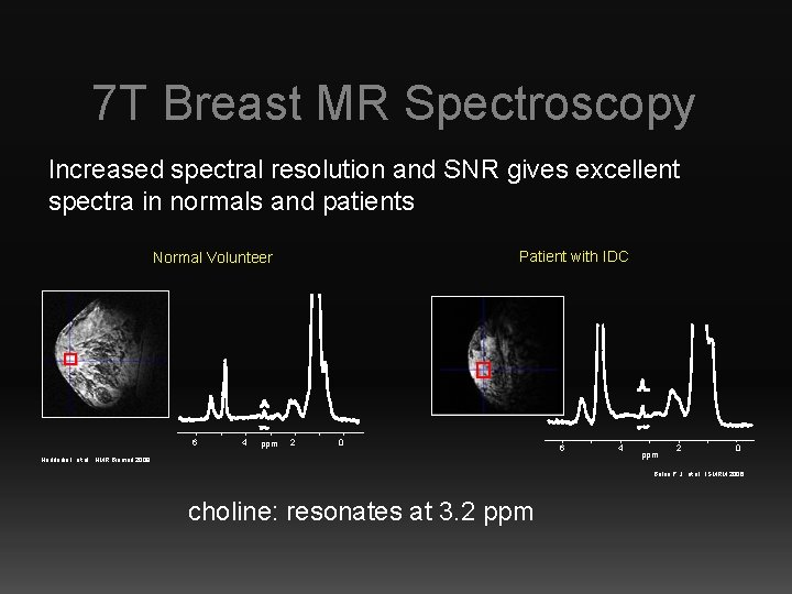7 T Breast MR Spectroscopy Increased spectral resolution and SNR gives excellent spectra in
