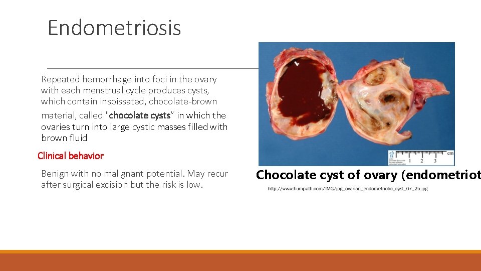 Endometriosis Repeated hemorrhage into foci in the ovary with each menstrual cycle produces cysts,
