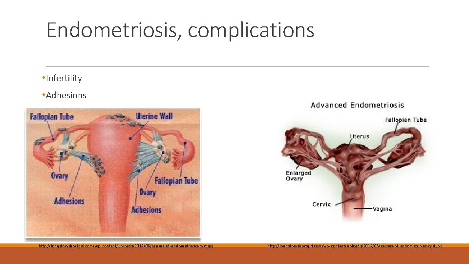 Endometriosis, complications • Infertility • Adhesions http: //longstoryshortgirl. com/wp-content/uploads/2014/08/causes-of-endometriosis-cyst. jpg 