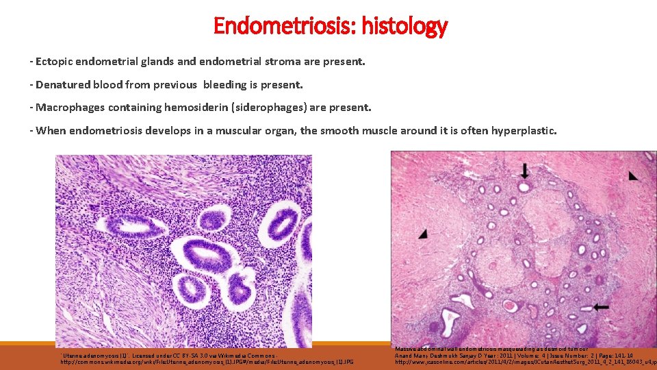 Endometriosis: histology - Ectopic endometrial glands and endometrial stroma are present. - Denatured blood