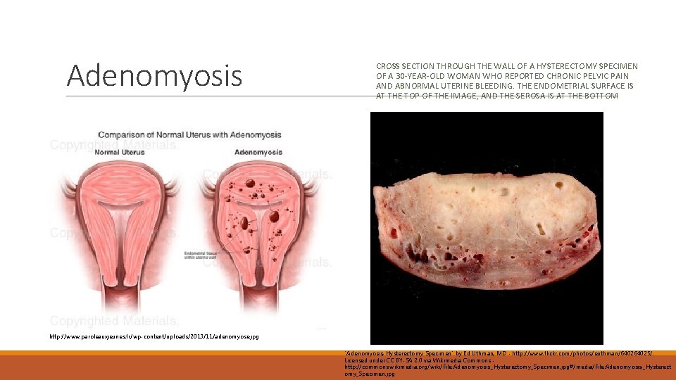 Adenomyosis CROSS SECTION THROUGH THE WALL OF A HYSTERECTOMY SPECIMEN OF A 30 -YEAR-OLD
