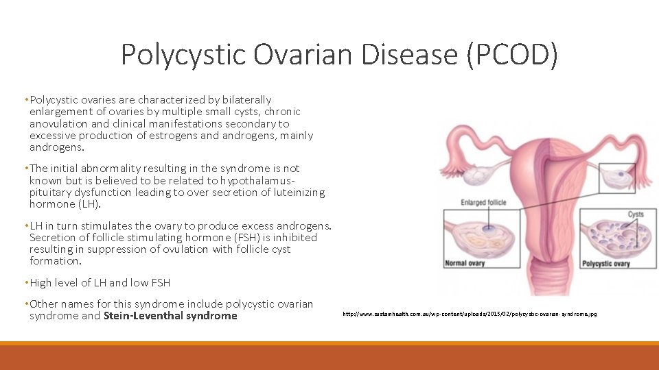 Polycystic Ovarian Disease (PCOD) • Polycystic ovaries are characterized by bilaterally enlargement of ovaries