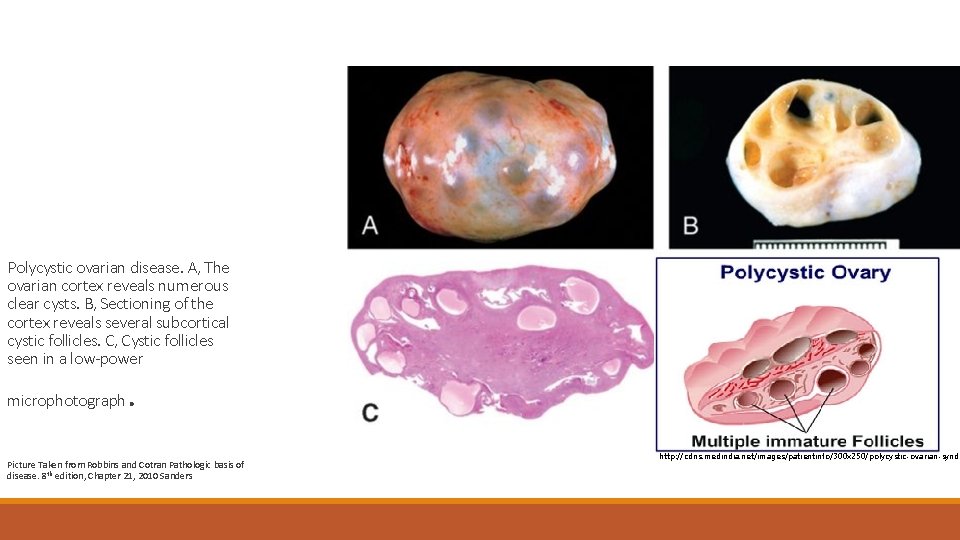 Polycystic ovarian disease. A, The ovarian cortex reveals numerous clear cysts. B, Sectioning of