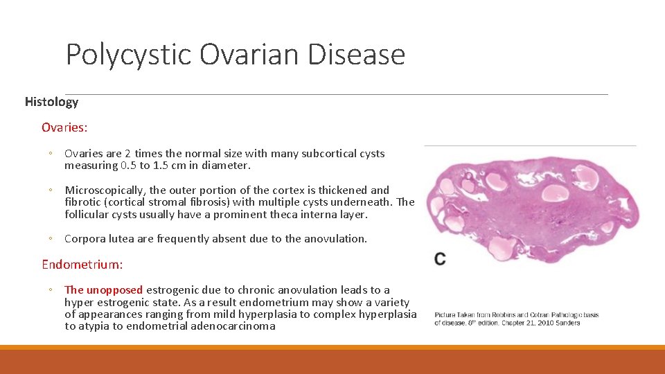 Polycystic Ovarian Disease Histology Ovaries: ◦ Ovaries are 2 times the normal size with
