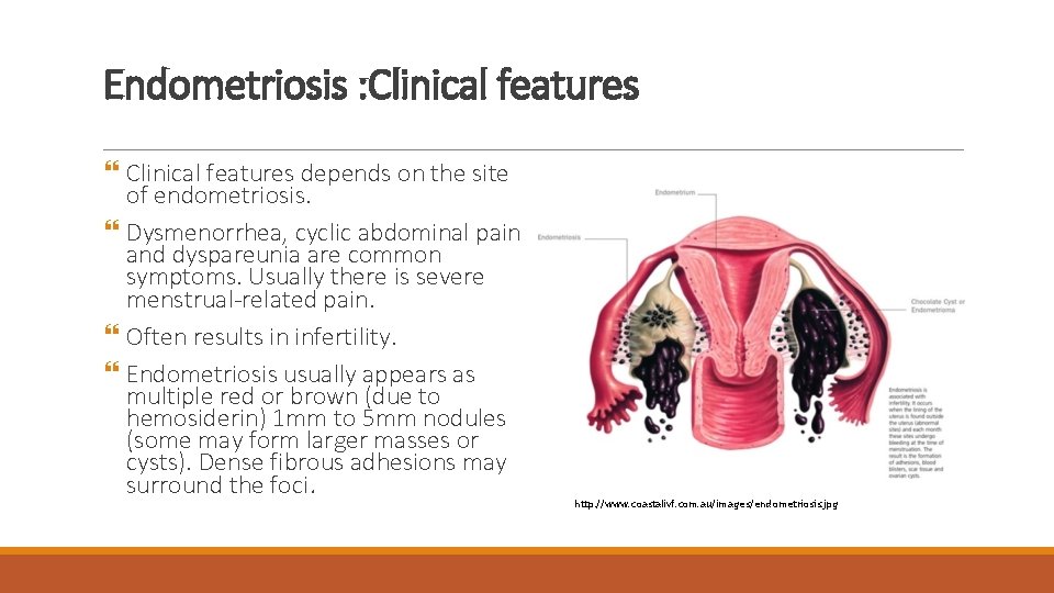 Endometriosis : Clinical features depends on the site of endometriosis. Dysmenorrhea, cyclic abdominal pain