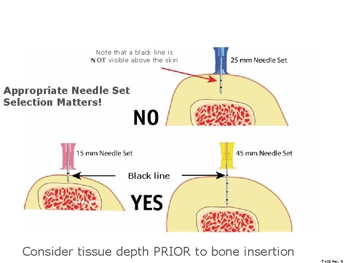 Note that a black line is NOT visible above the skin Appropriate Needle Set