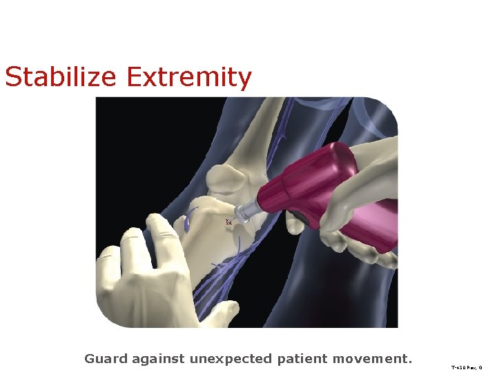 Stabilize Extremity Guard against unexpected patient movement. T-430 Rev, G 