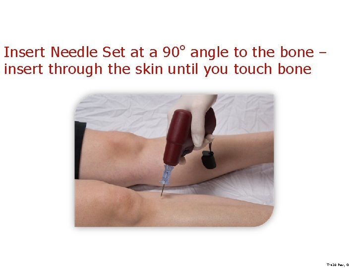 Insert Needle Set at a 90 o angle to the bone – insert through