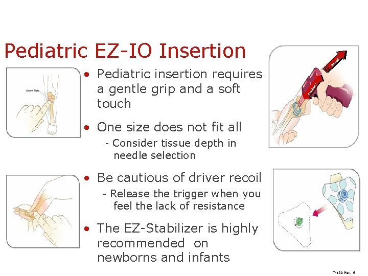 Pediatric EZ-IO Insertion n! tio Ca u • Pediatric insertion requires a gentle grip