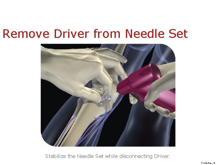 Remove Driver from Needle Set Stabilize the Needle Set while disconnecting Driver. T-430 Rev,