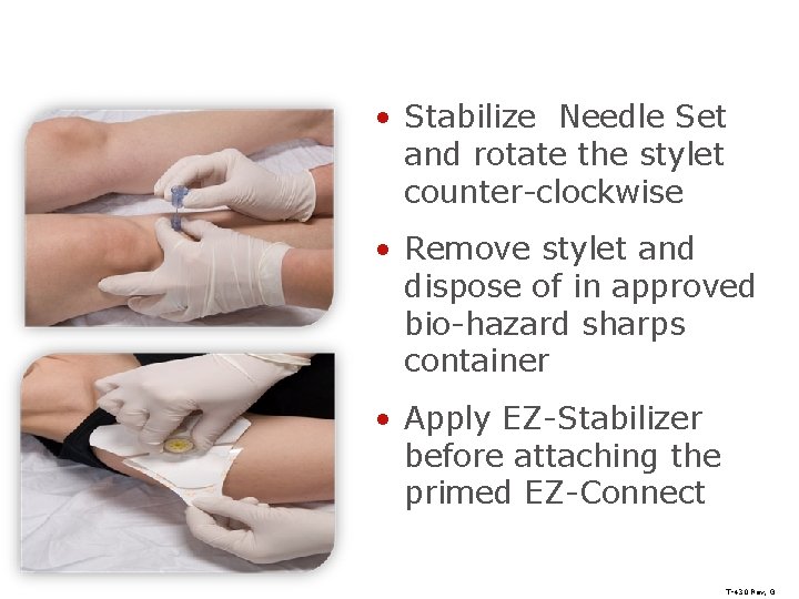 Removal of the Stylet • Stabilize Needle Set and rotate the stylet counter-clockwise •