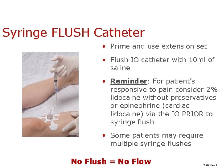 Syringe FLUSH Catheter • Prime and use extension set • Flush IO catheter with