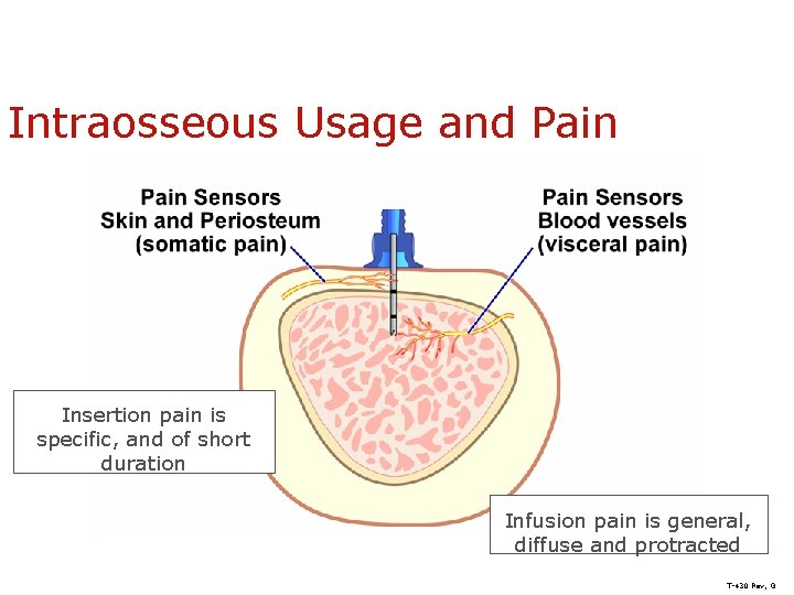 Intraosseous Usage and Pain Insertion pain is specific, and of short duration Infusion pain