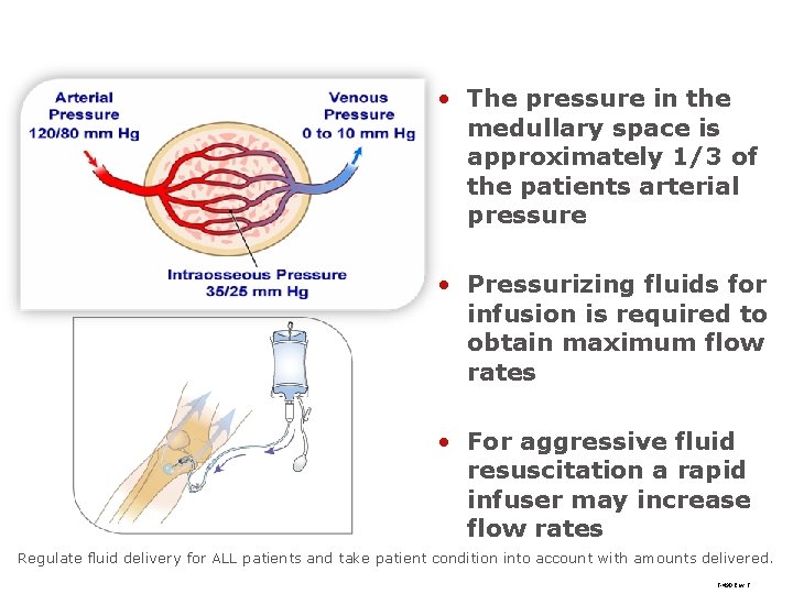  • The pressure in the medullary space is approximately 1/3 of the patients