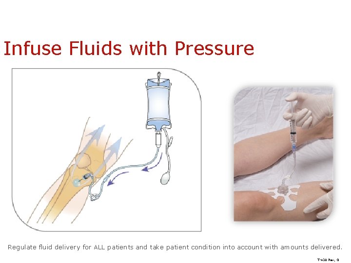 Infuse Fluids with Pressure Regulate fluid delivery for ALL patients and take patient condition