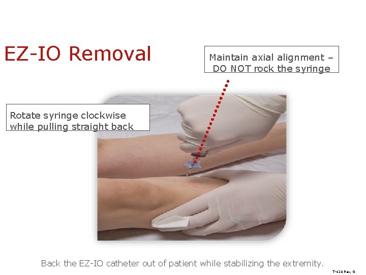 EZ-IO Removal Maintain axial alignment – DO NOT rock the syringe Rotate syringe clockwise