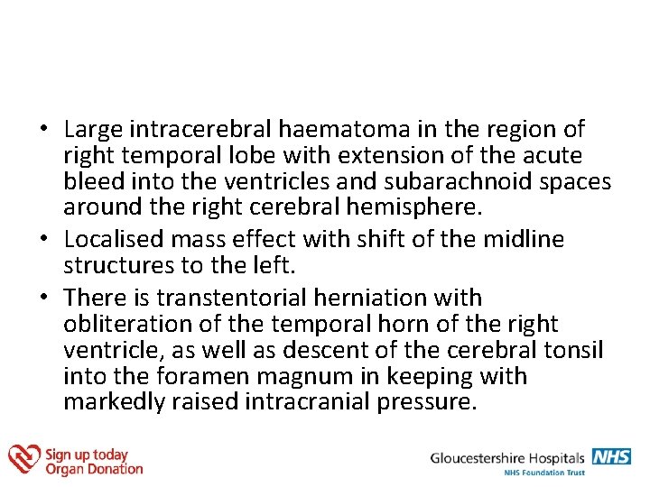  • Large intracerebral haematoma in the region of right temporal lobe with extension