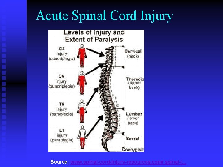 Acute Spinal Cord Injury Source: www. spinal-cord-injury-resources. com/ spinal-i. . . 
