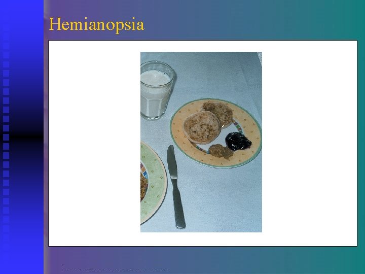 Hemianopsia 