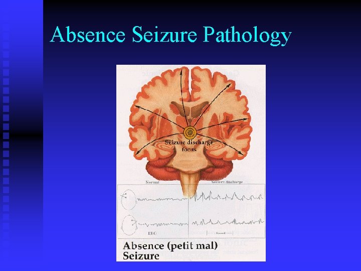 Absence Seizure Pathology 