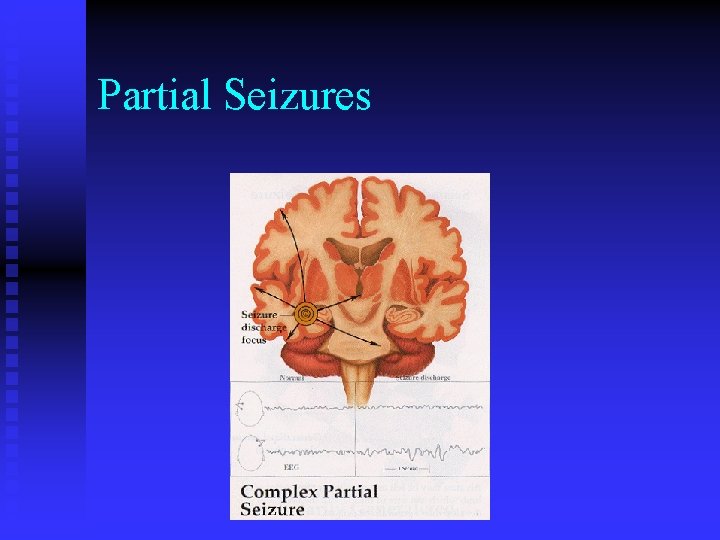 Partial Seizures 