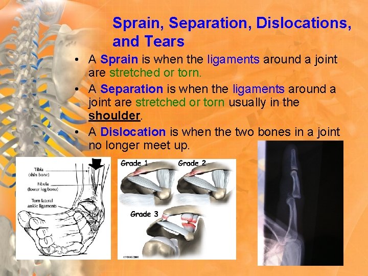 Sprain, Separation, Dislocations, and Tears • A Sprain is when the ligaments around a