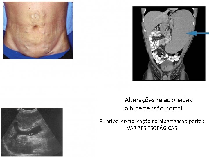 Alterações relacionadas a hipertensão portal Principal complicação da hipertensão portal: VARIZES ESOFÁGICAS 