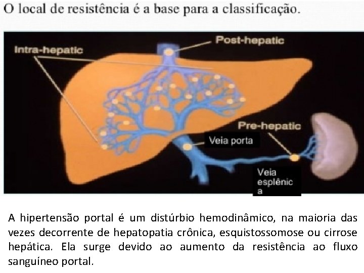 A hipertensão portal é um distúrbio hemodinâmico, na maioria das vezes decorrente de hepatopatia