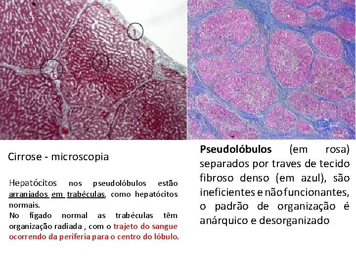 Cirrose - microscopia Hepatócitos nos pseudolóbulos estão arranjados em trabéculas, como hepatócitos normais. No