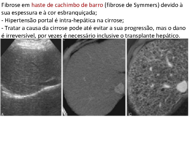 Fibrose em haste de cachimbo de barro (fibrose de Symmers) devido à sua espessura