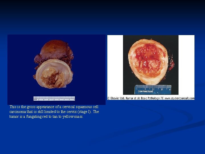 This is the gross appearance of a cervical squamous cell carcinoma that is still