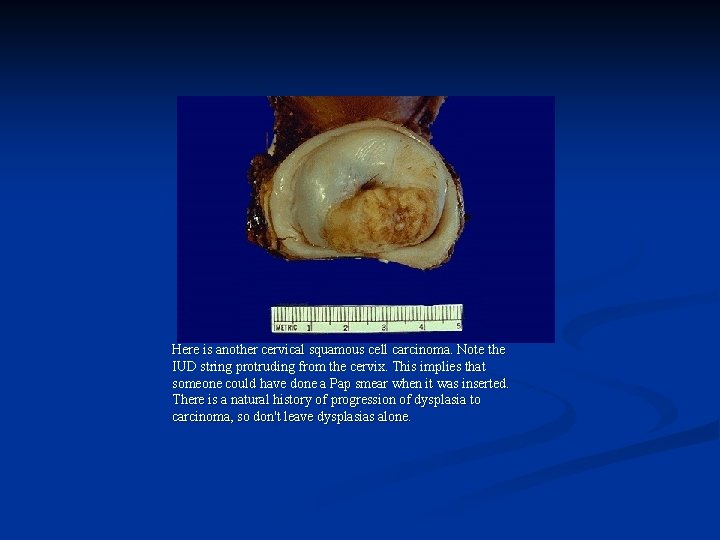 Here is another cervical squamous cell carcinoma. Note the IUD string protruding from the